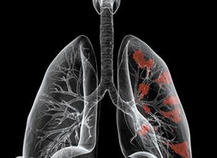 防治肺癌始于戒烟